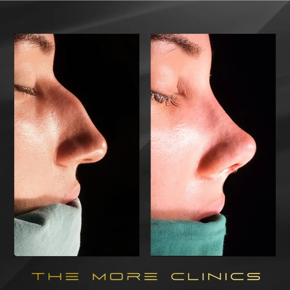crooked nose rhinoplasty before and after septoplasty