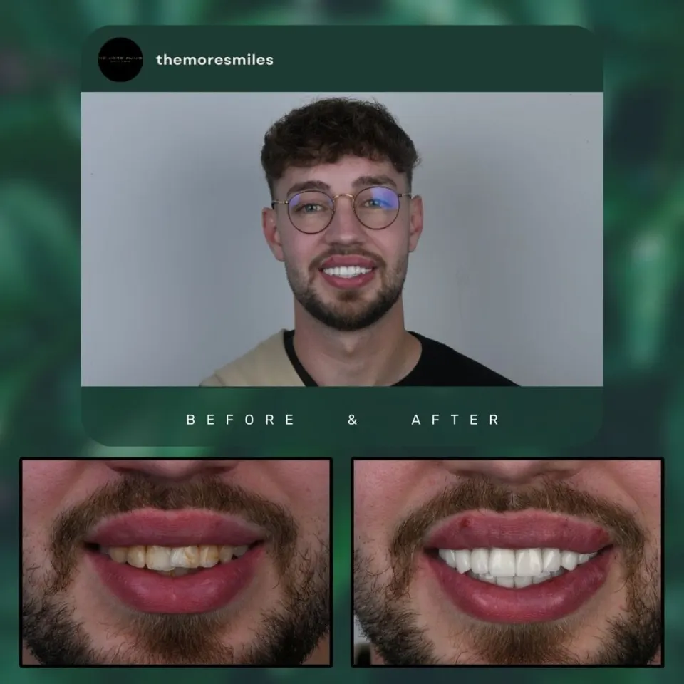 Dental before & after 46