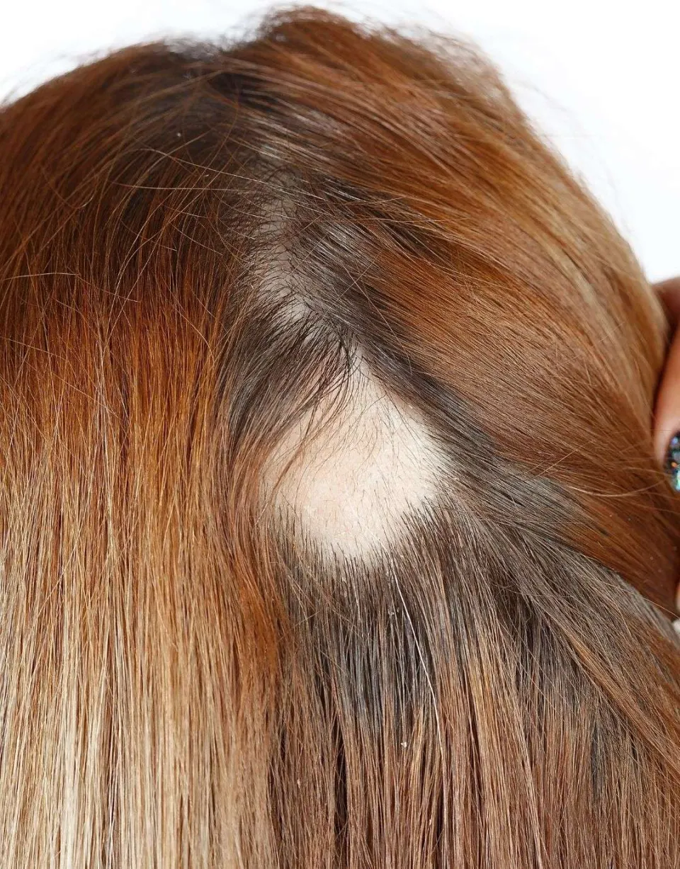 Alopecia Areata example in woman