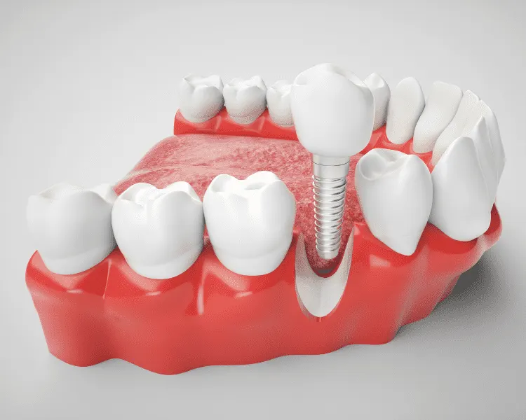 Dental implant replacing a missing tooth — implant, abutment, crown
