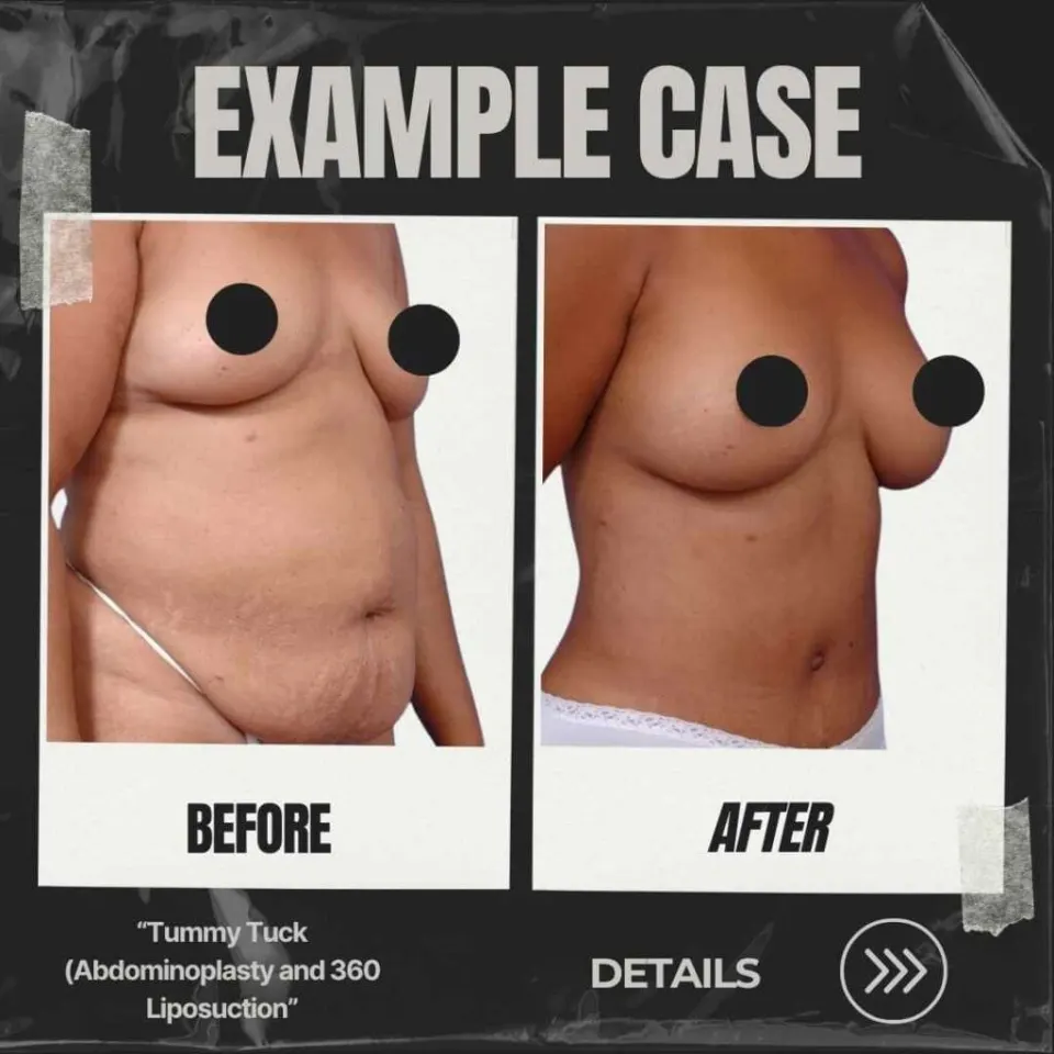 reverse tummy tuck before after
