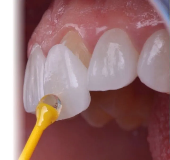 antalya dental veneers before and after