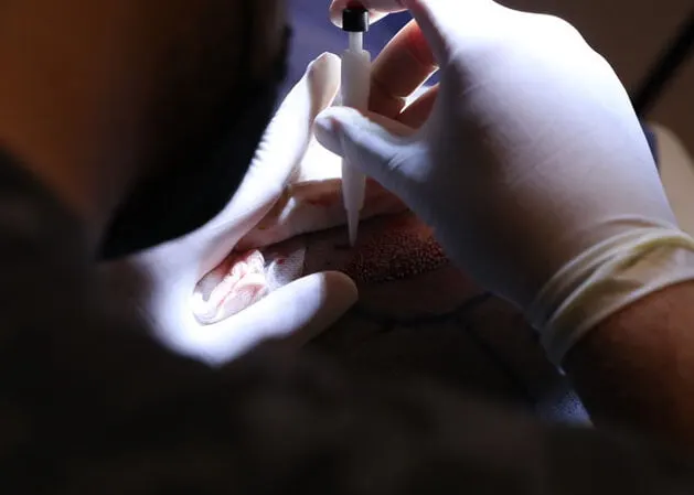 Antalya DHI Hair Transplant Turkey