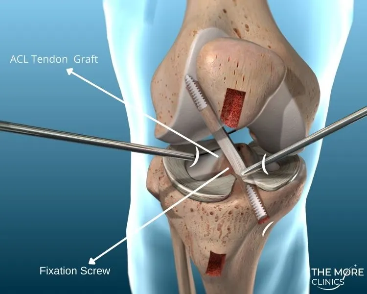 ACL Reconstruction Surgery Turkey