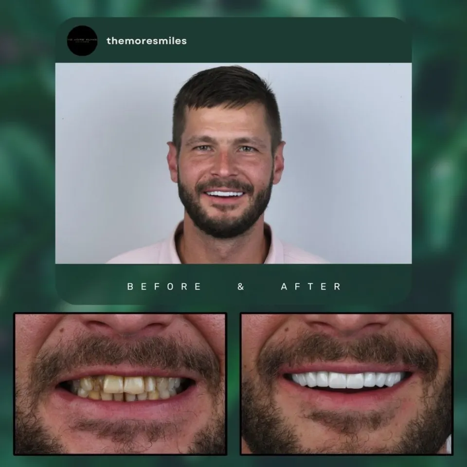 Dental before & after 33