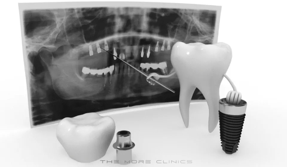 Antalya Dental Implants