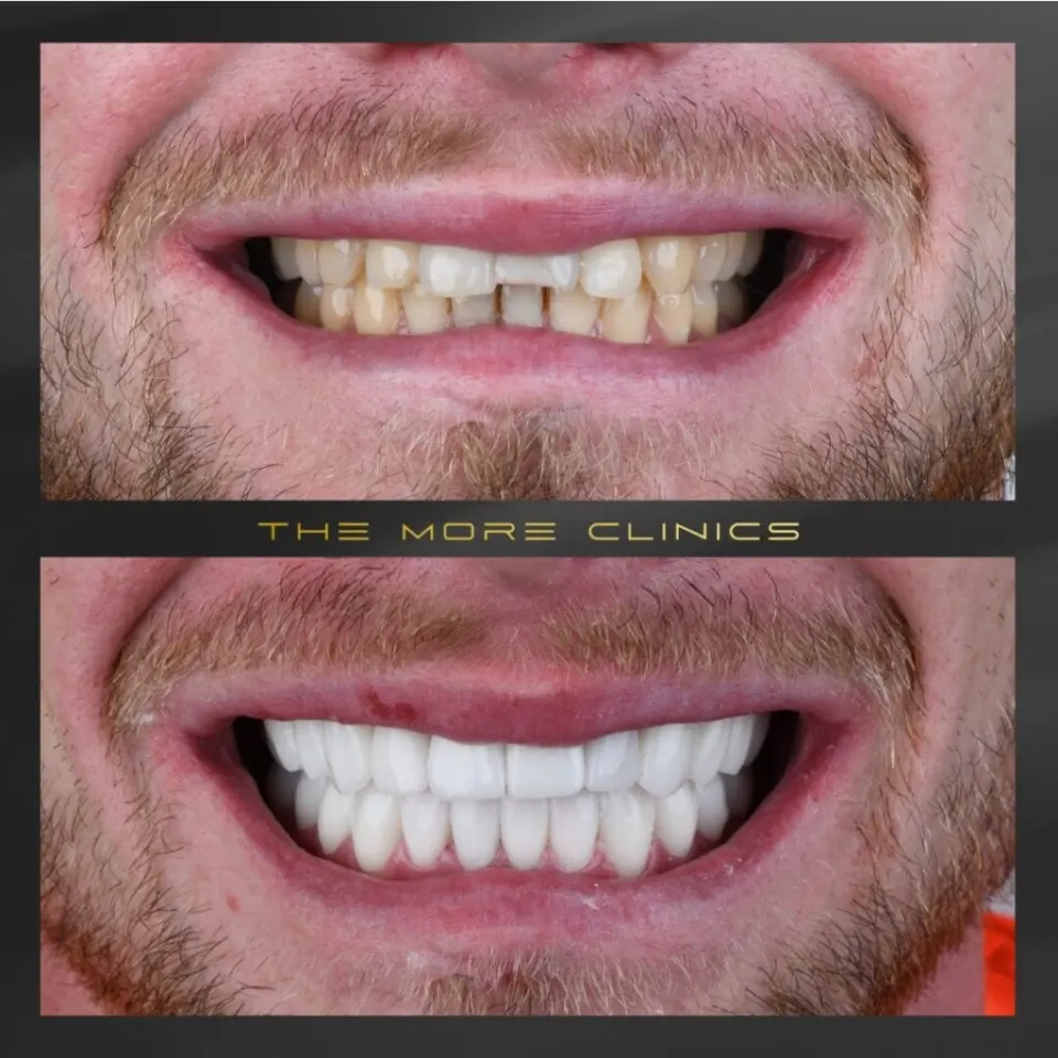 hollywood smile with dental crowns before and after in antalya turkey