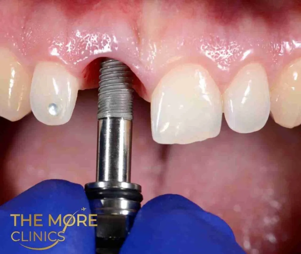 tooth implant failure