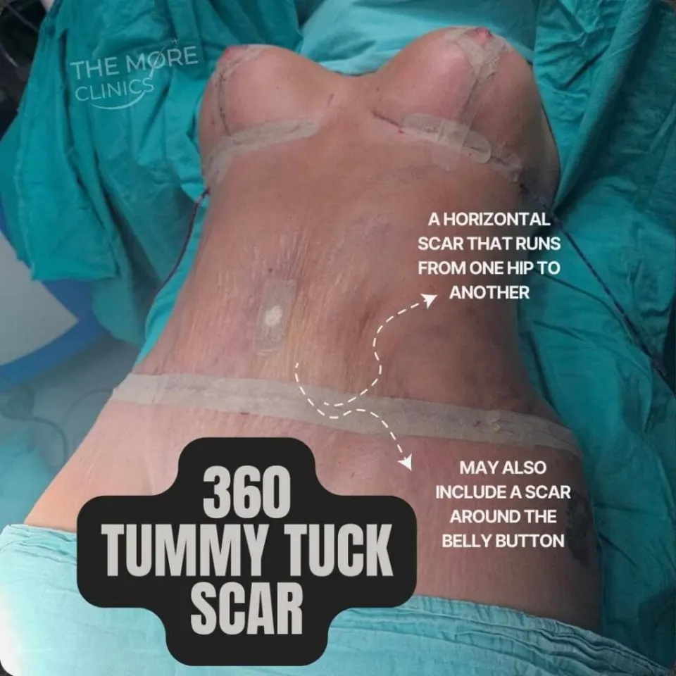 full tummy tuck scar photos