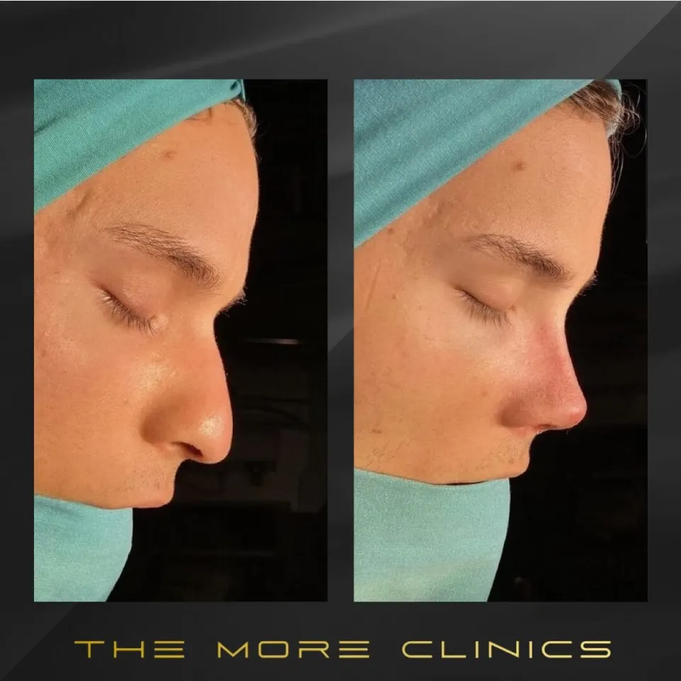 natural nose job before and after rhinoplasty