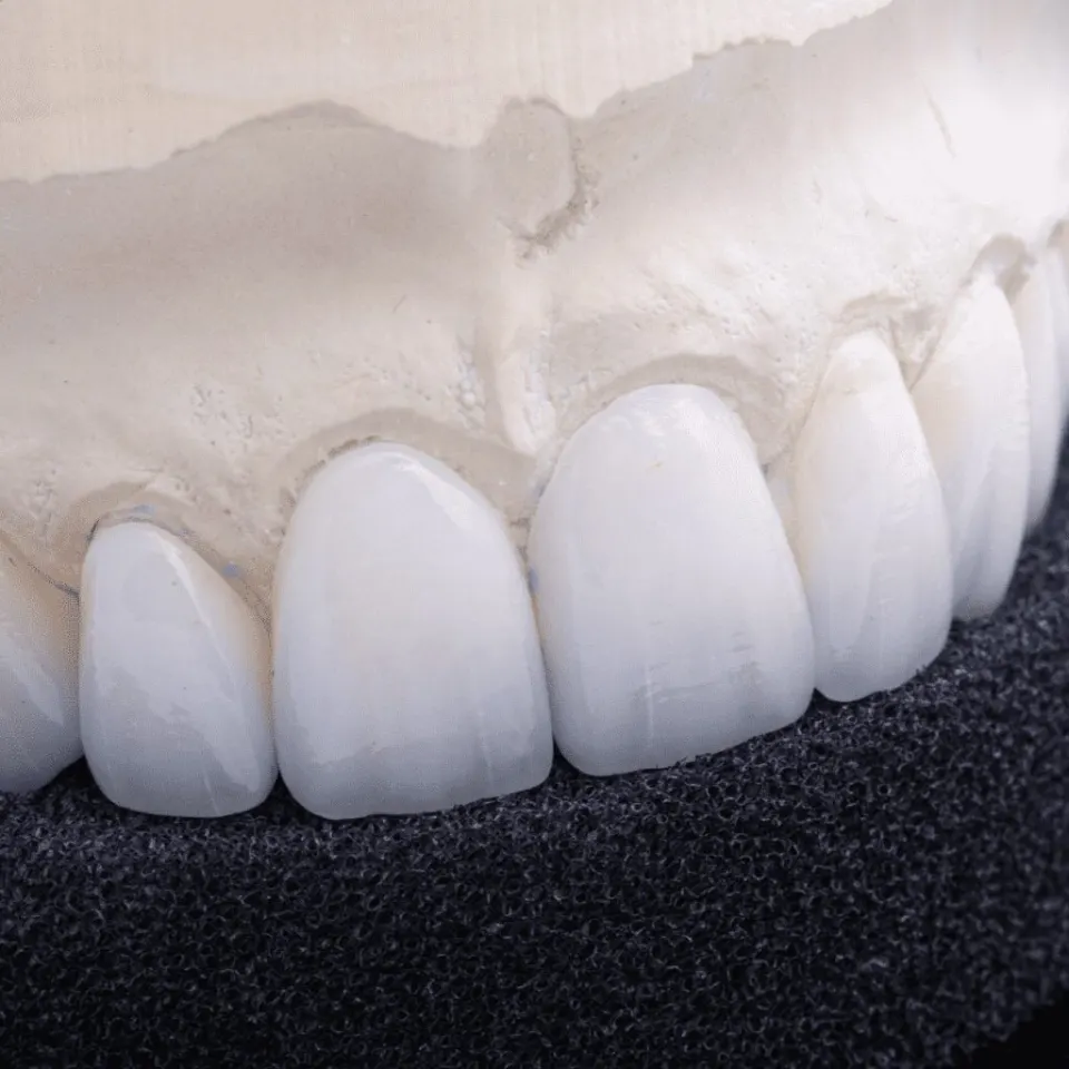 Dental crown aftercare — complete care guide 2026