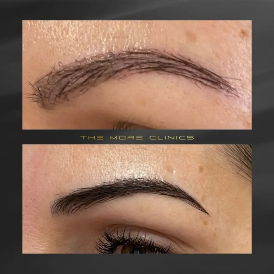 Eyebrow transplant before after in Turkey — thinning eyebrows restored