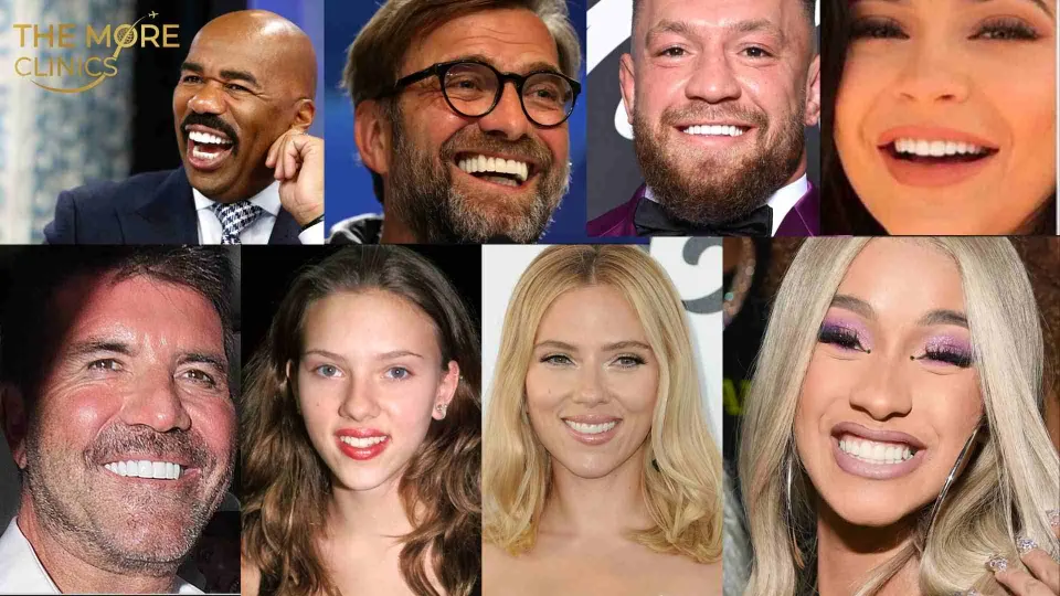 celebrities with veneers