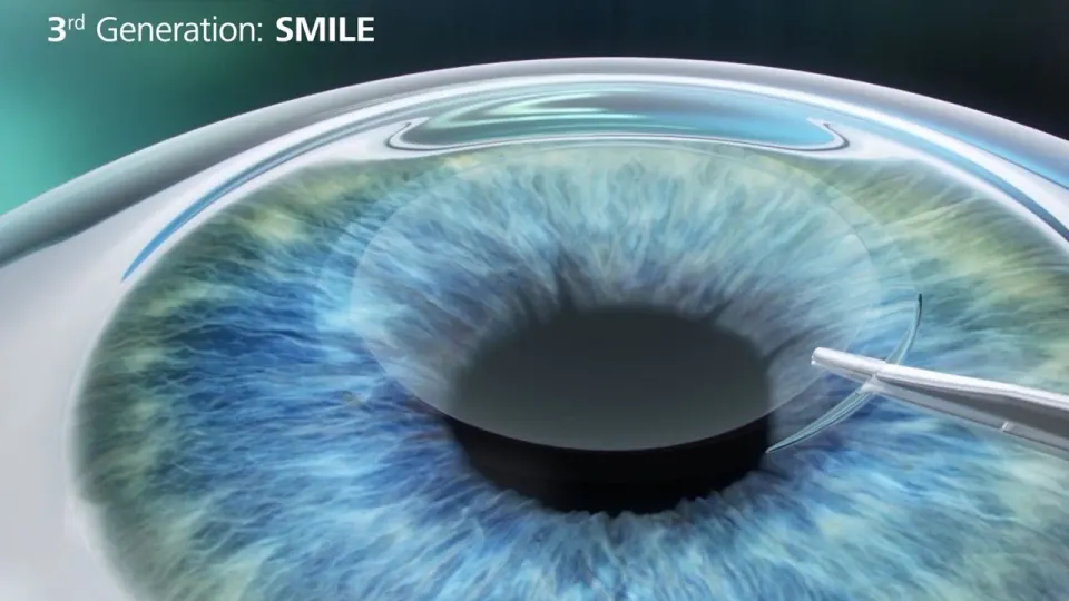 3rd generation of eye surgery