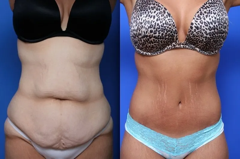 turkey mommy makeover before and after