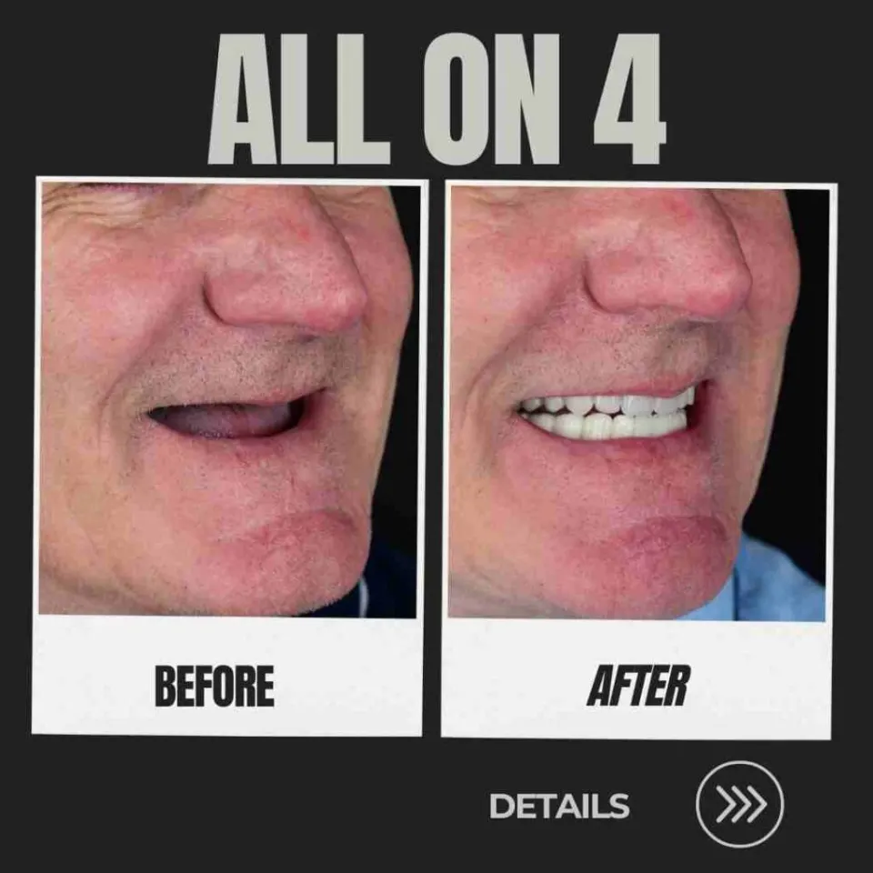 All-on-4 dental implants Turkey before and after — full arch missing teeth replaced