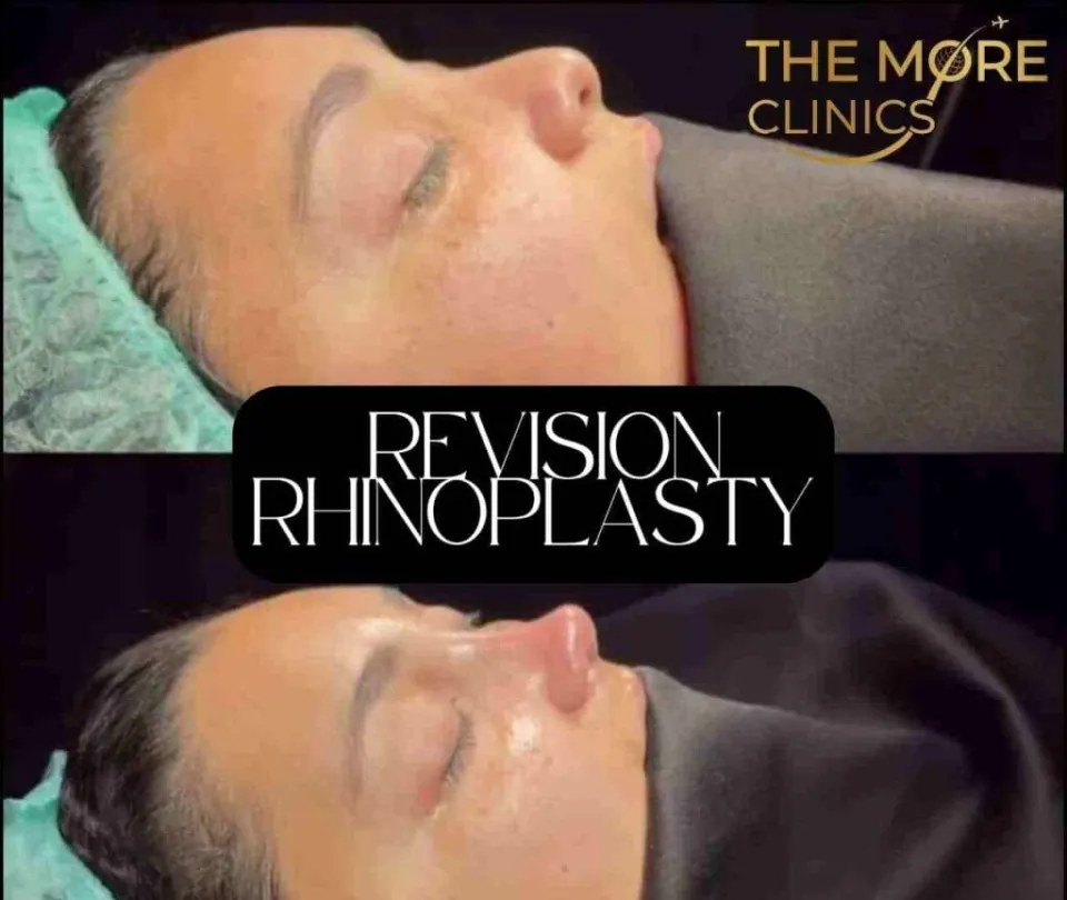 revision rhinoplasty before after turkey nose job