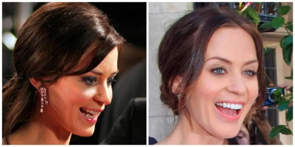 Emily Blunt Teeth Before After celebrities with veneers