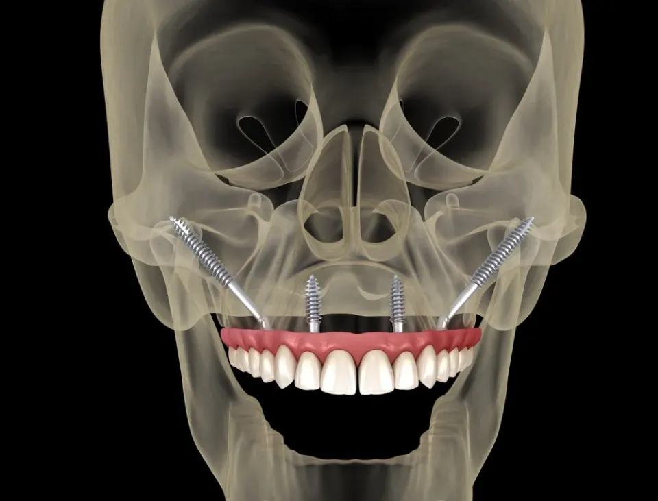 zygomatic full arch dental implants