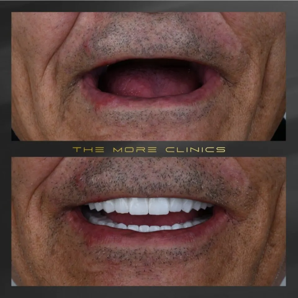 Missing tooth replaced with dental implant Turkey before and after