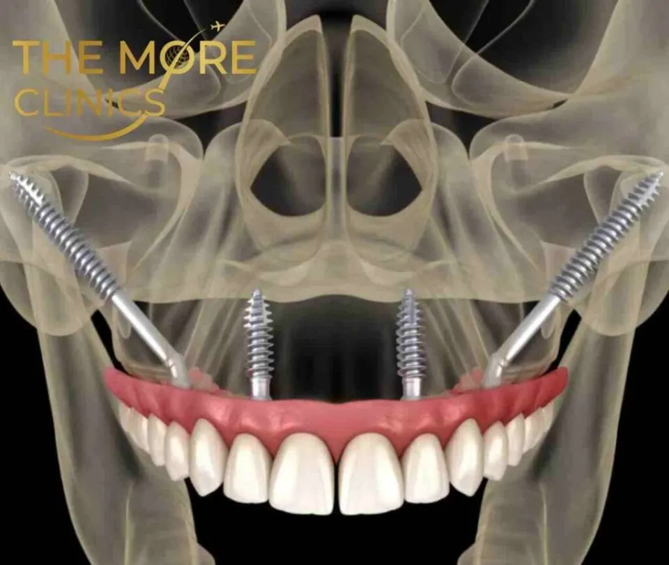 zygoma implantat türkei jochbeinimplantat