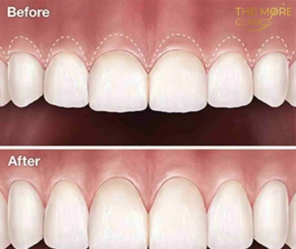 crown lenghtening before and after
