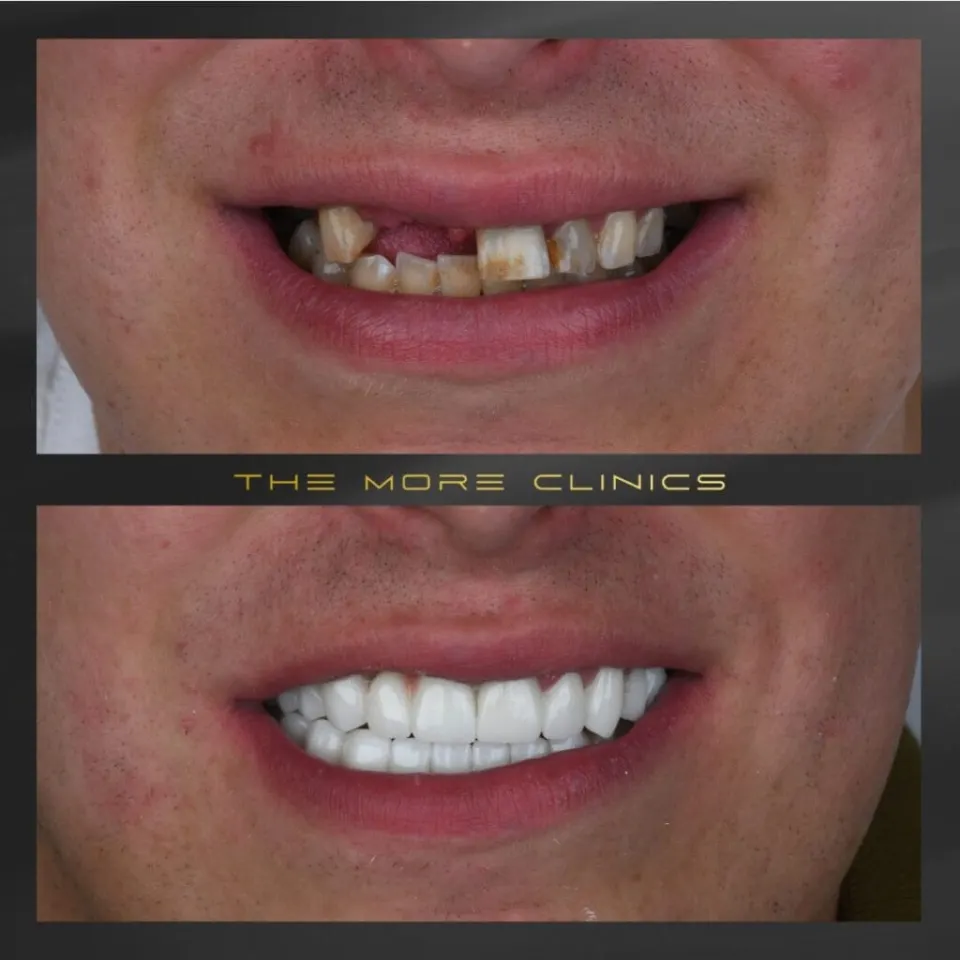 dental implants turkey and dental crowns before and after