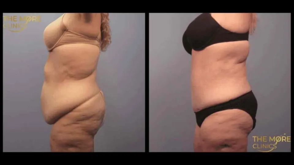 Liposuccion 360 en Turquie avant et après