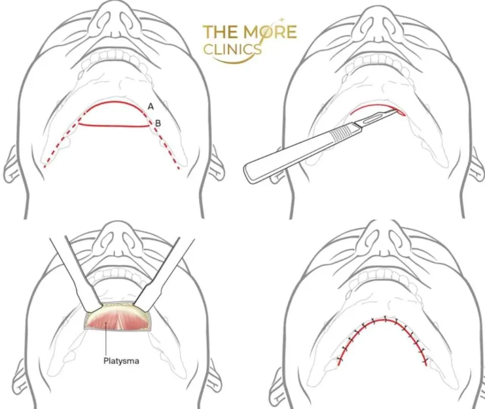 turkey neck lift surgical steps
