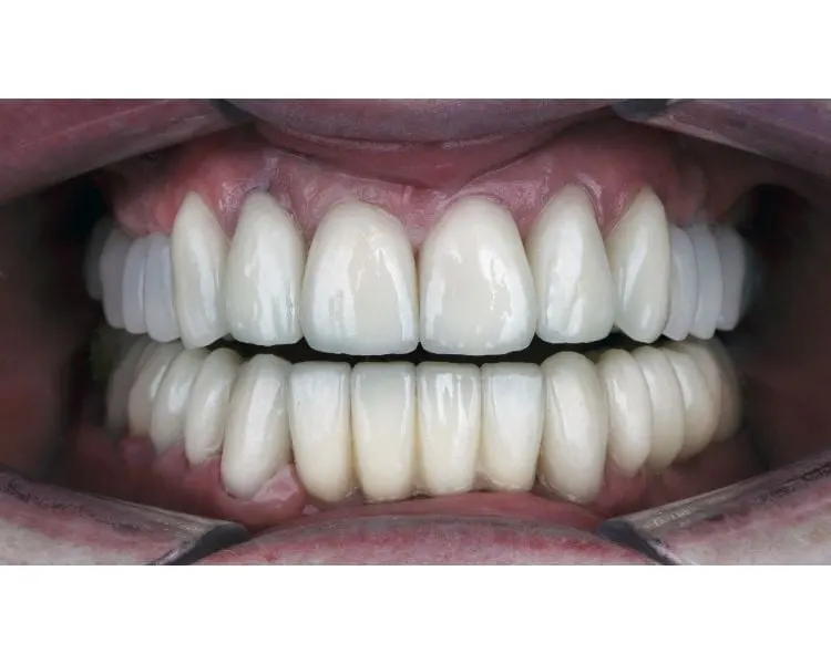 turkey teeth gone wrong example of a patient