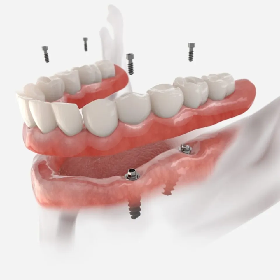 All on 4 Dental Implants in Turkey, Antalya –Costs and Packages