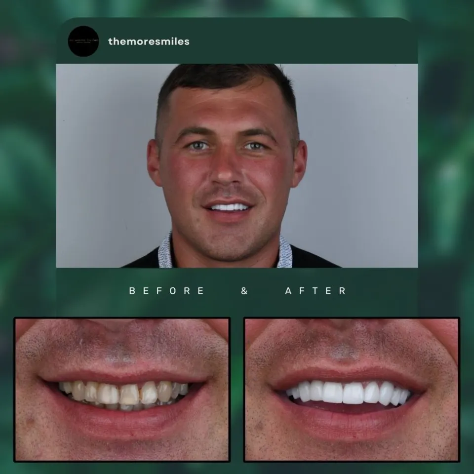 Porcelain veneers result before after Turkey