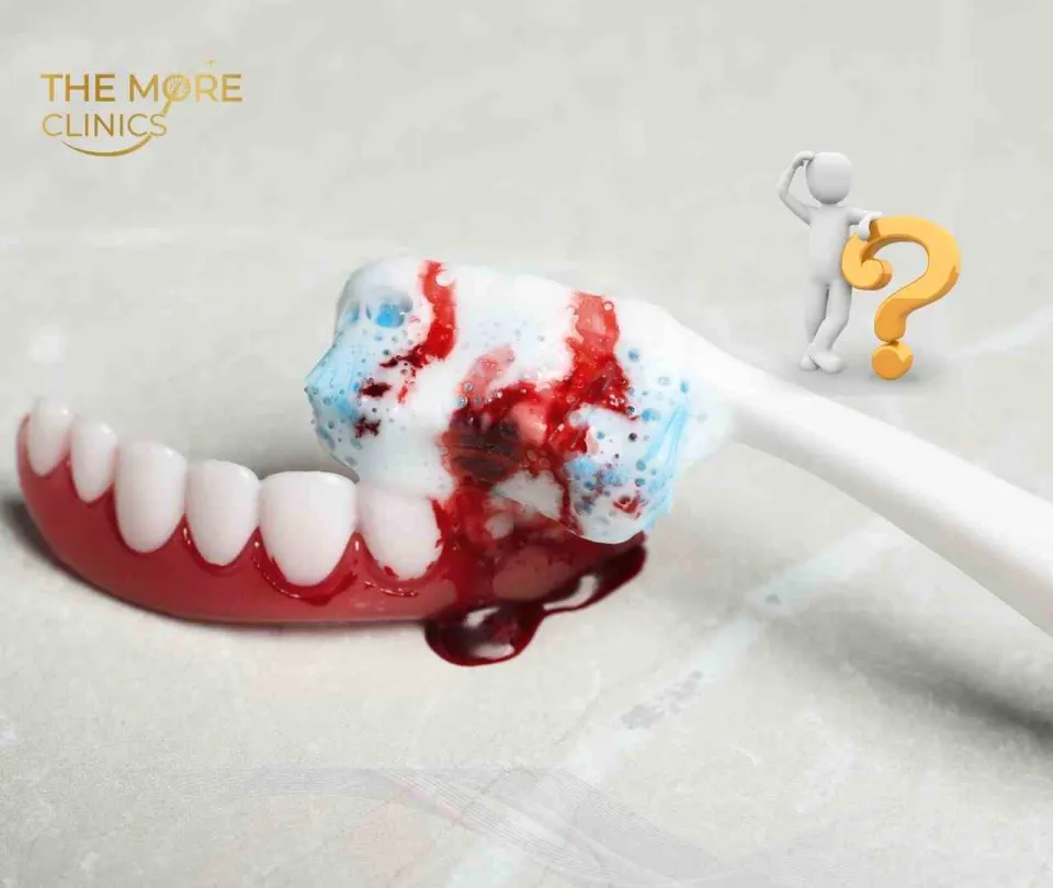 deep teeth cleaning