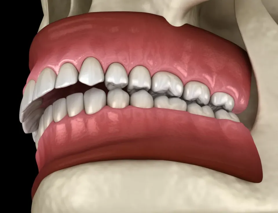 Antalya jaw overbite