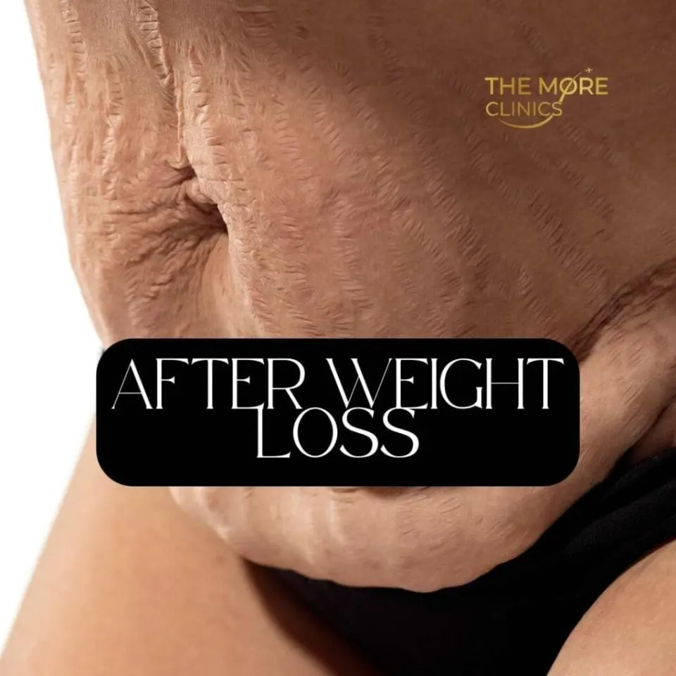 loose skin and body Dysmorphia after gastric sleeve surgery