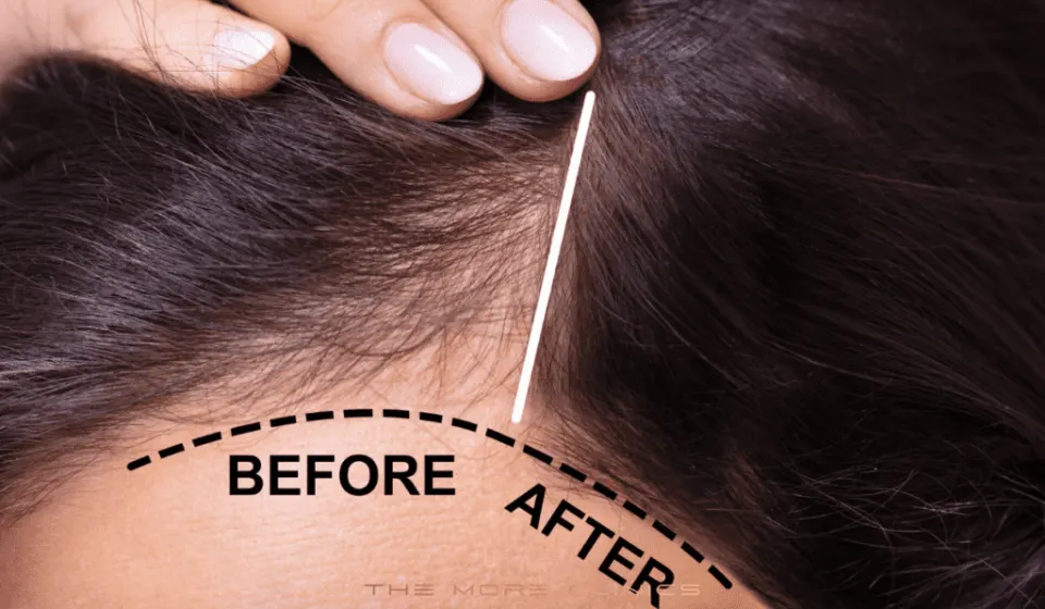 result of hair loss treatment at home