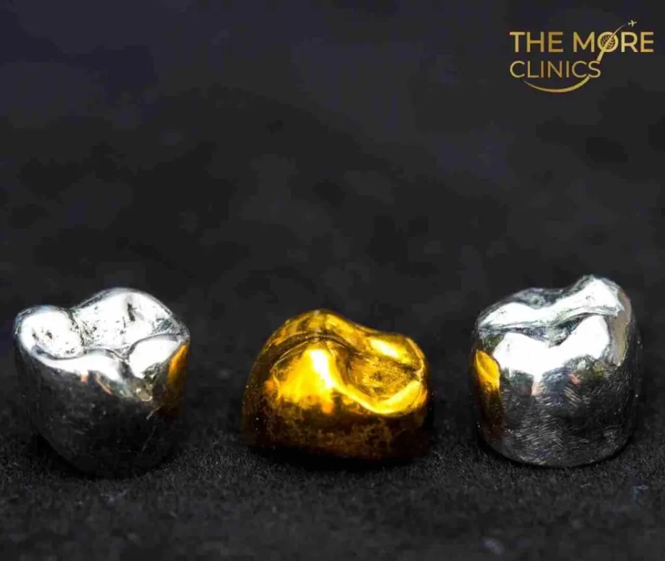 Gold crown — most durable dental crown type and cost
