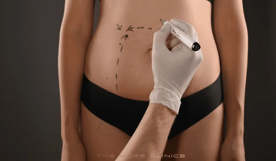 Antalya Liposuction