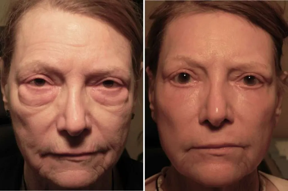 Eyelid surgery before and after Antalya Turkey — blepharoplasty result