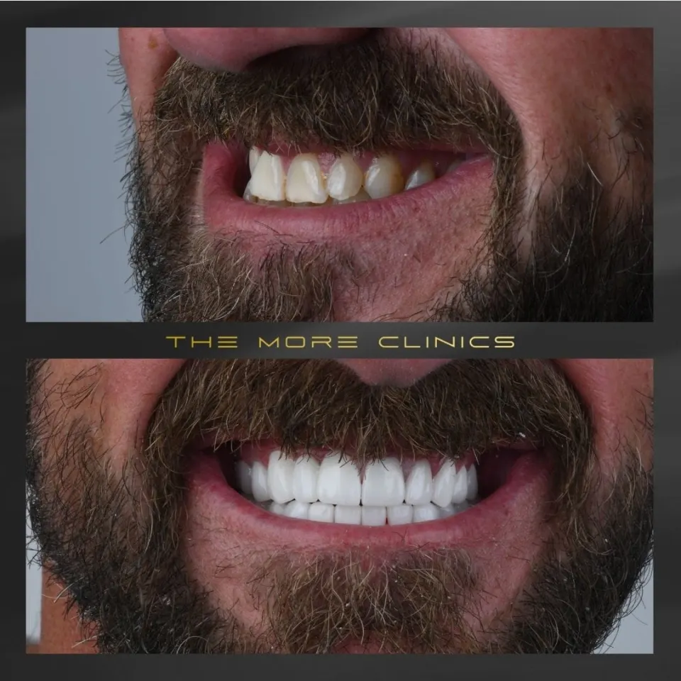 Dental before & after 42