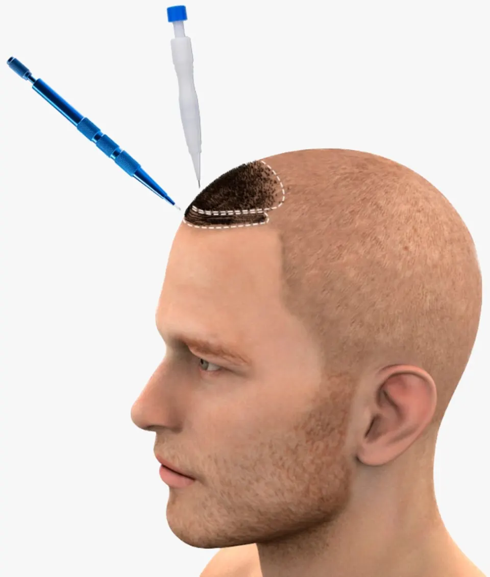 hair transplant antalya grefting procedure