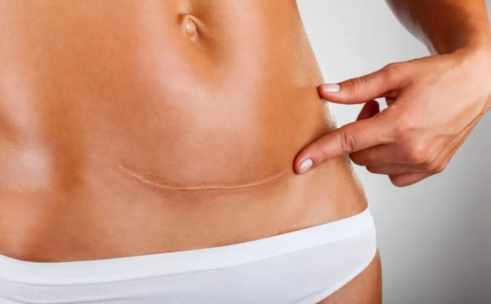 tummy tuck scars after 5 years