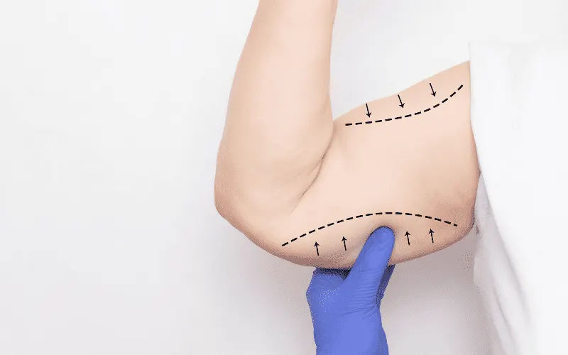Arm liposuction Turkey — arm contouring surgery