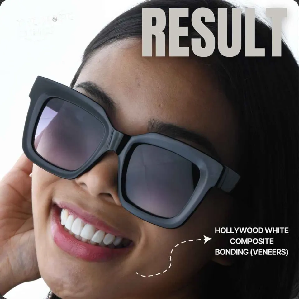 komposit veneers vorher nachher