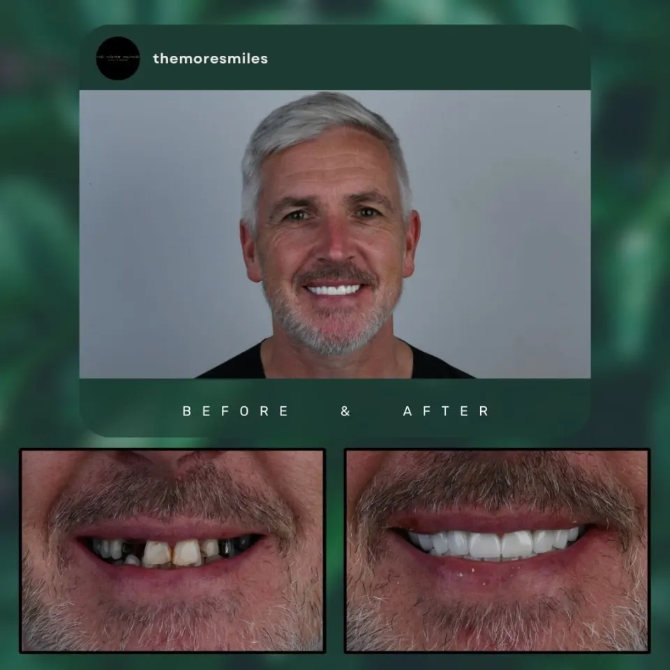 Dental before & after 44
