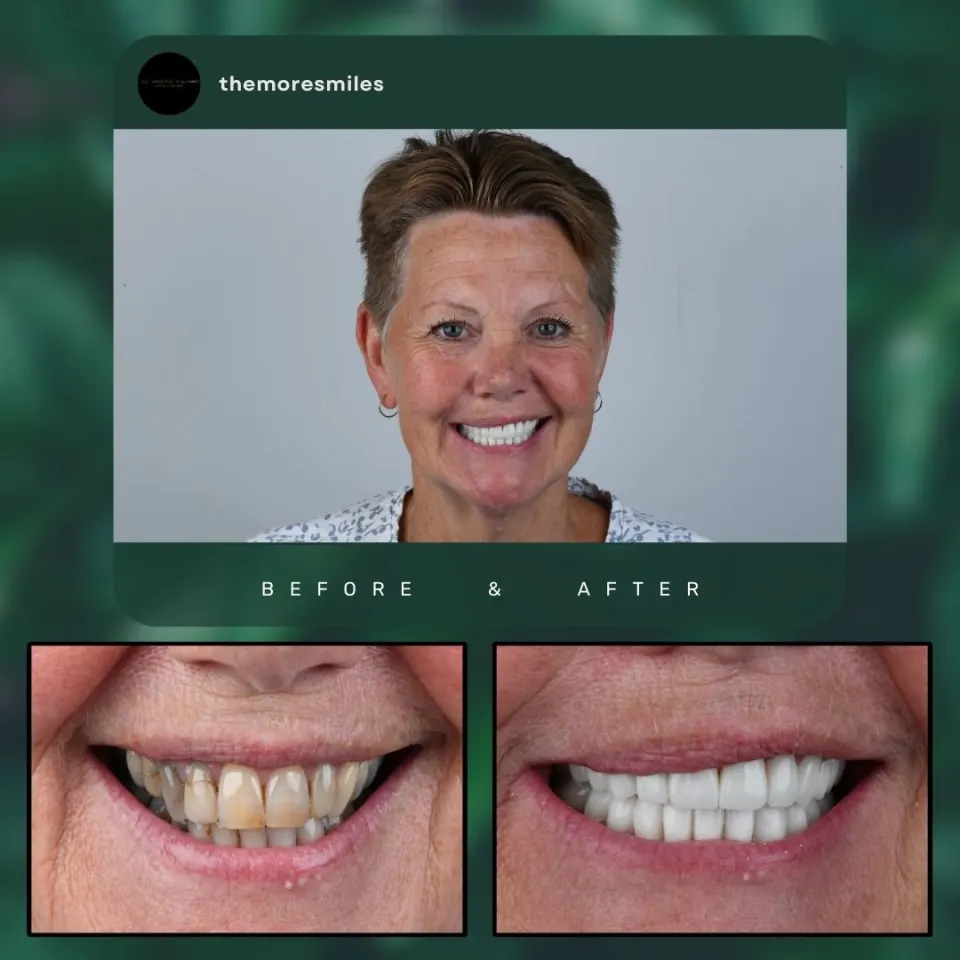 Antalya Dental Crowns