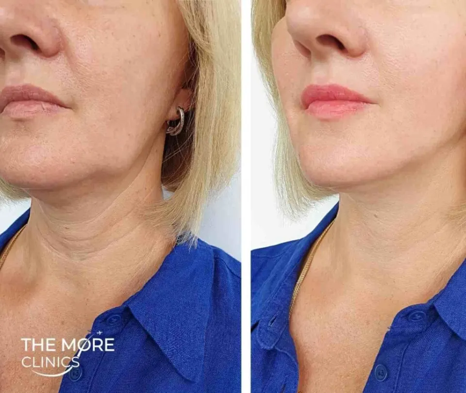 Deep plane facelift Turkey before and after result