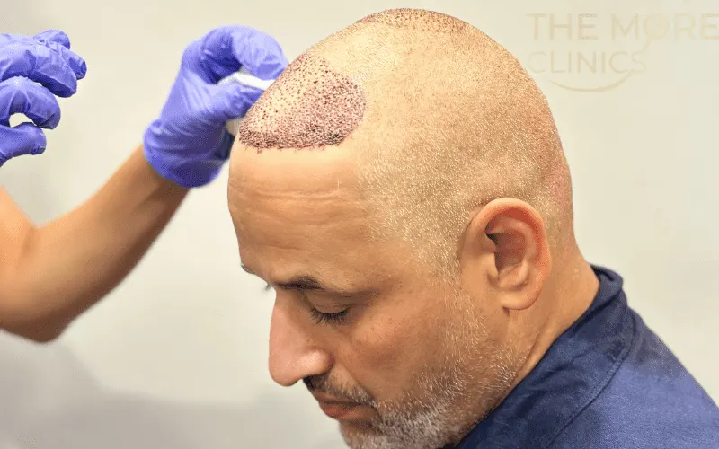 haartransplantation antalya erfahrungen