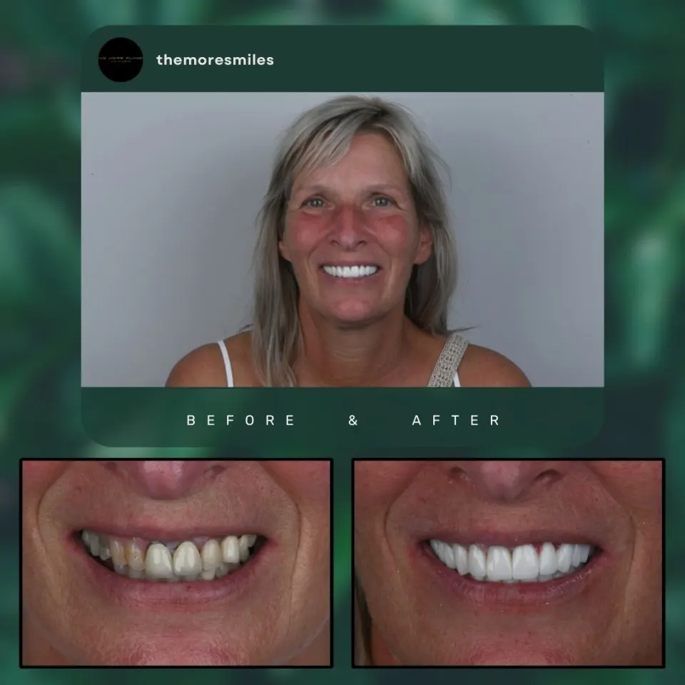 Antalya Dental Crowns