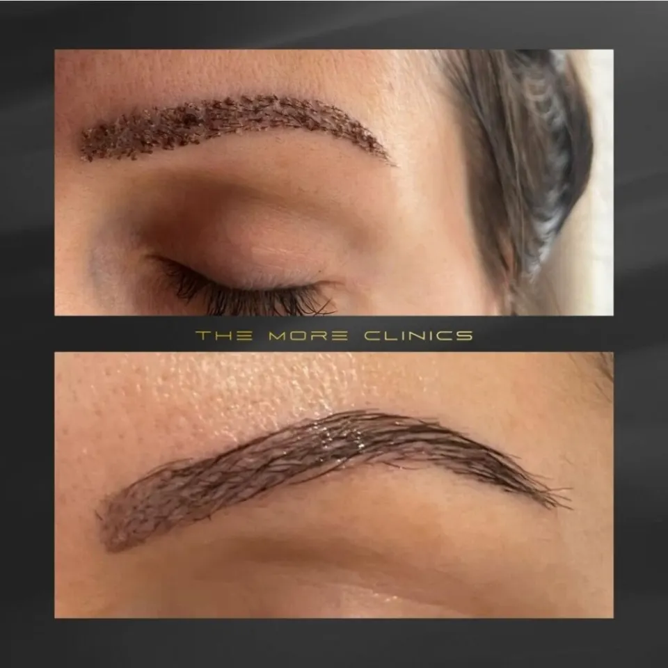 Eyebrow transplantation before after Antalya Turkey — sparse to full